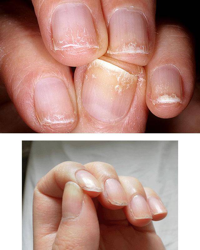 Лечение псориаза на ногтях
