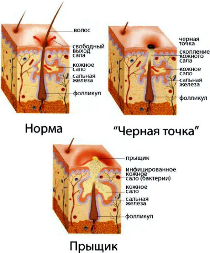 Комедоны на лице: виды, причины появления, советы,  как избавиться от комедонов, и способы  удаления комедонов в домашних условиях