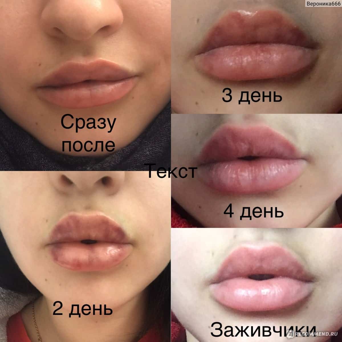 Препараты для увеличения губ названия и фото