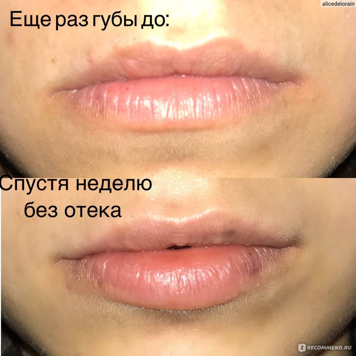 Каким должен быть уход за губами после инъекций гиалуроновой кислоты?