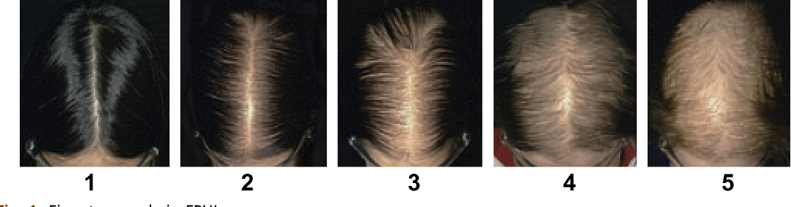 Задача: распознать врага! типы выпадения волос у женщин - центр эстетической медицины