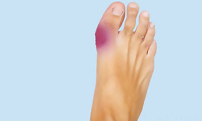 Ушиб пальца на ноге: как понять, не перелом ли это, как выглядит, признаки и симптомы, сколько проходит, лечение
