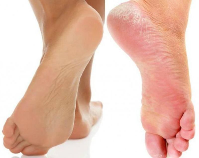 Почему чешутся ноги после душа, что делать, если после душа сильный зуд кожи ног – эл клиника