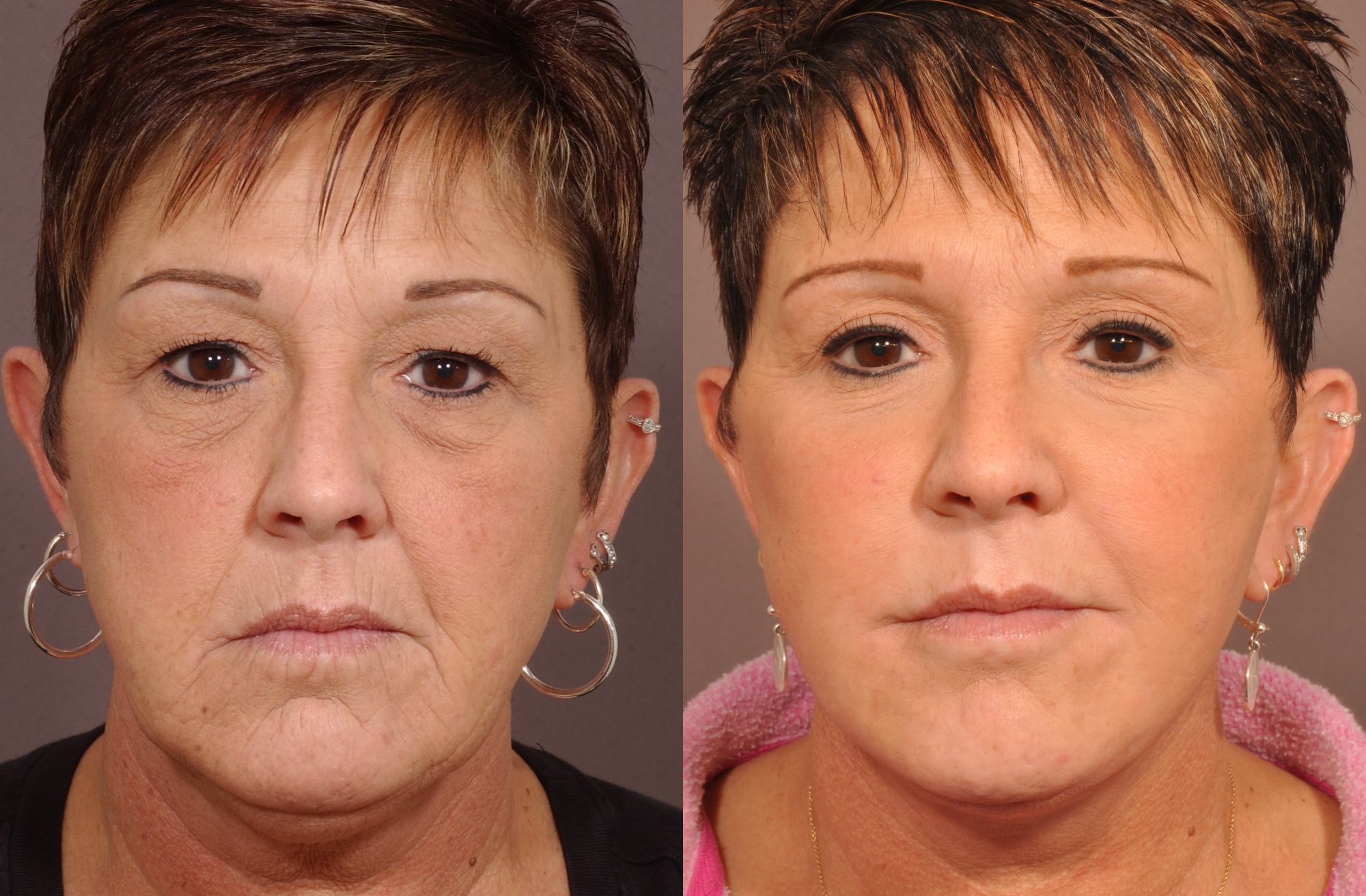 Алмазный пилинг лица - результаты и отзывы. фото до и после