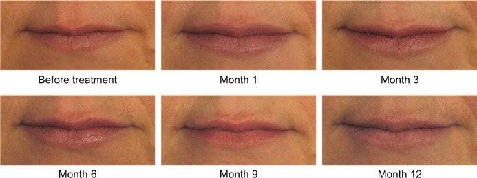 Способы увеличения губ