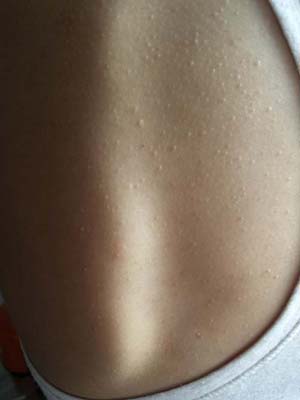 Прыщи на груди у женщин: причины, последствия, методы лечения