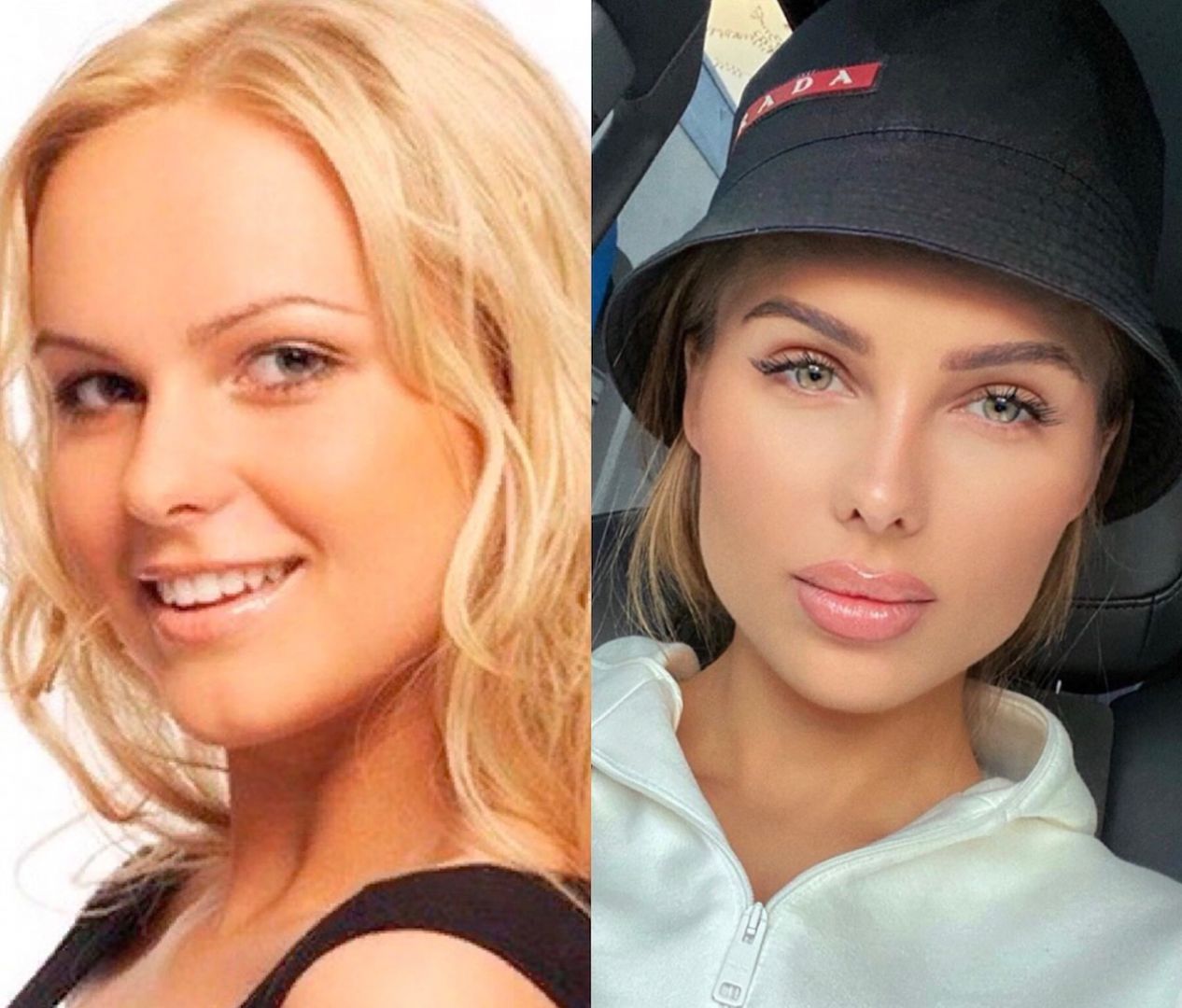 Ханна российская певица до и после пластических операций: какая она – анна ? до пластики и после +фото и видео