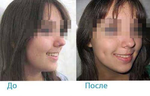 Рак «съел» нижнюю челюсть: как врачи восстанавливают внешность людям «без лица»
