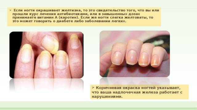 Почему желтеют ногти на руках у женщины
