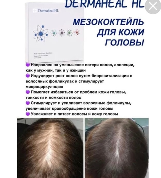 Лечение волос при помощи мезотерапии препаратом dermaheal hl