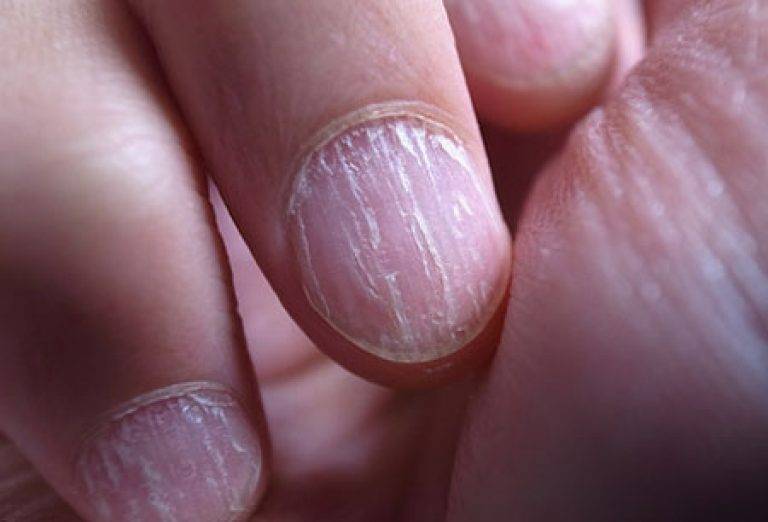 Как определить, что у вас грибок ногтей: 15 шагов