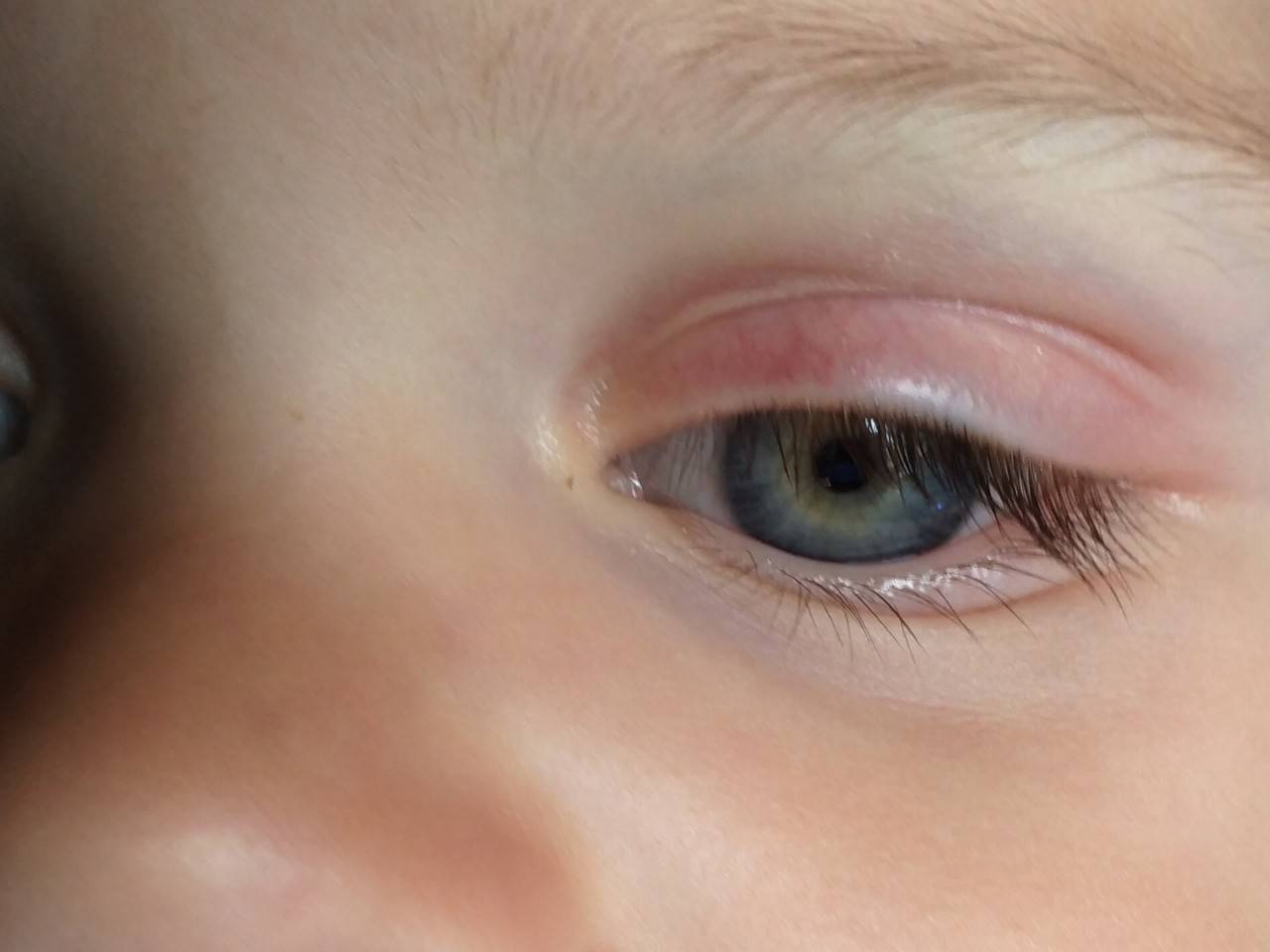 Темные пятна под глазами у ребенка — откуда?