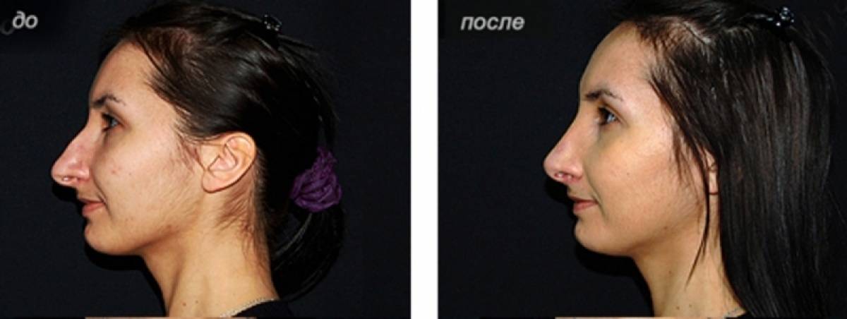 Выше нос: как укорачивающая ринопластика меняет лицо (10 женщин до и после) | bonamoda | дзен