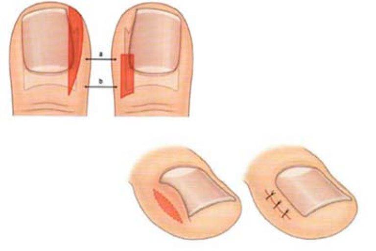 Краевая резекция ногтевой пластинки — клиника "виромед"