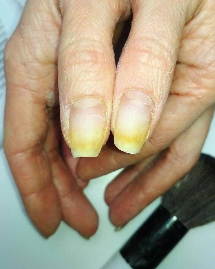 Почему желтеют ногти на руках?