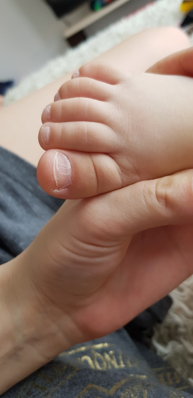 У ребенка слоятся ногти на руках (или ногах): причины и лечение | ru-babyhealth