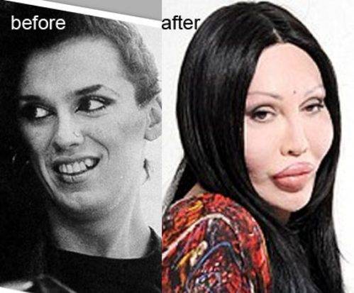Фото до и после пластики звезд российских, зарубежных, голливуда, шоу-бизнеса, эстрады. удачные и неудачные операции