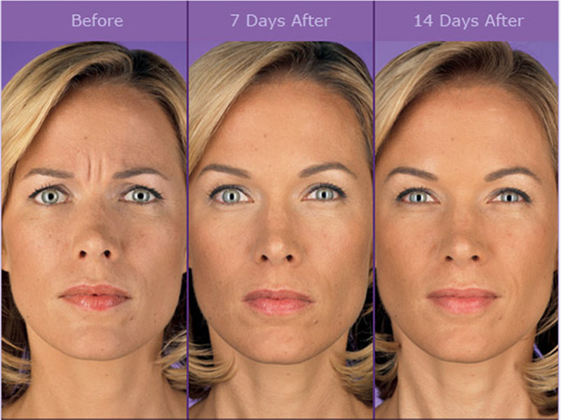 Эффект  "надутого лица": почему после введения филлеров возникает деформация внешности | а клиника