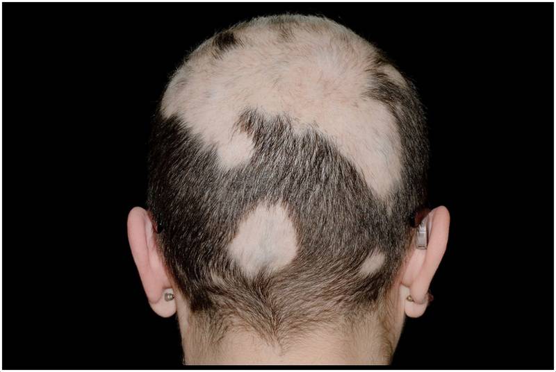 Облысение – лечение и причины облысения, борьба с симптомами раннего облысения - клиника «доктор волос»