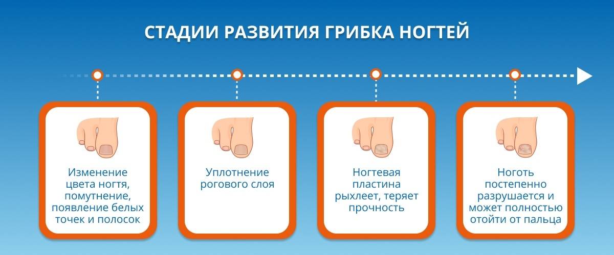 Микоз ногтей - симптомы, диагностика, лечение