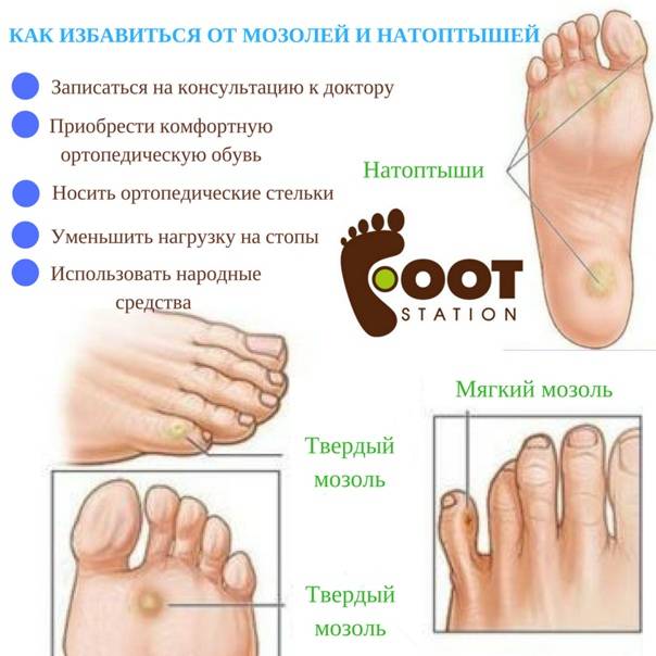 Как избавиться от мозоли в домашних условиях