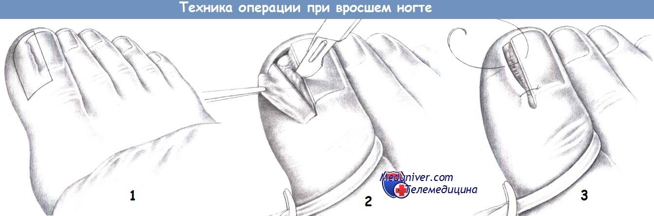Люмбоишалгия