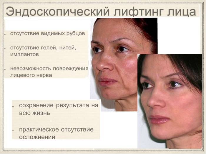 Эндоскопическая подтяжка. все об операции — новости и медиа | олимп клиник