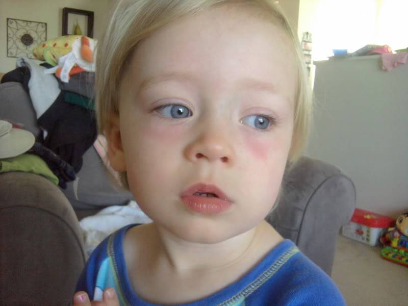 Красные точки под глазами у ребенка: причины, что делать