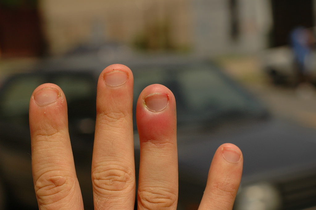 Воспаление пальца у ногтевой пластины — 25 ответов врачей на вопрос на сайте спросиврача