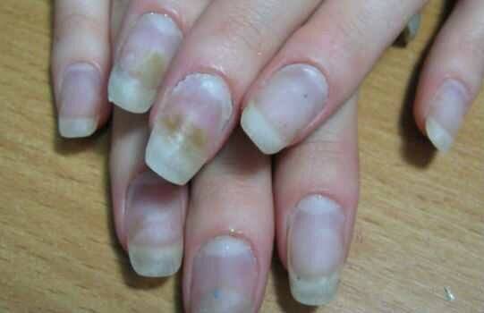Восстанавливающие процедуры для ногтей после наращивания