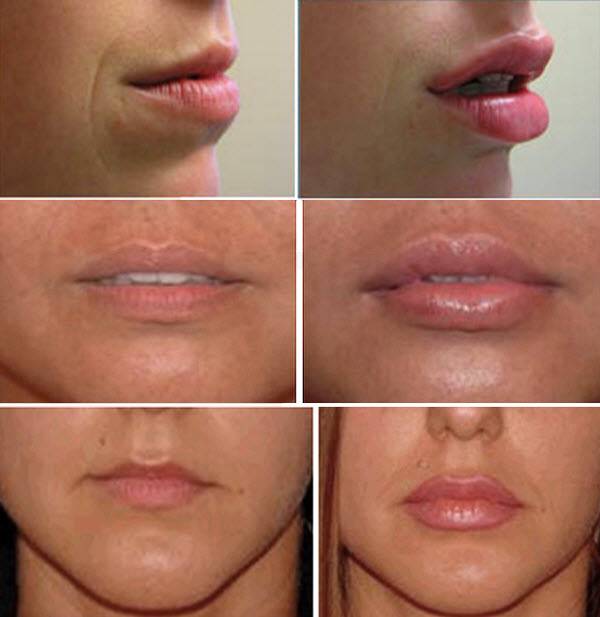 Моделирование губ гиалуроновой кислотой - плотные, влажные, чувственные - центр эстетической медицины