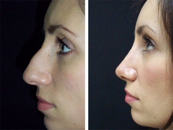 Коррекция носа филлерами в клинике константа в ярославле | стоимость контурной пластики носа