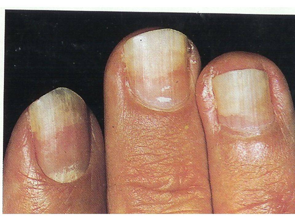 Микоз ногтей - симптомы, диагностика, лечение