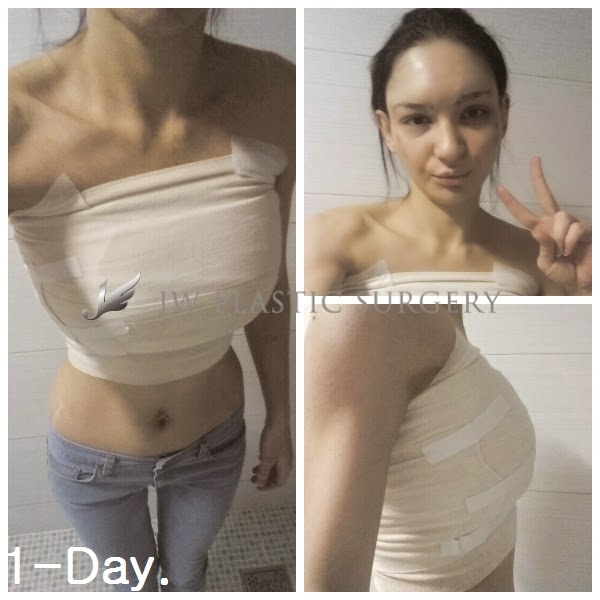 Подтяжка груди - фото до и после операции в клинике эталон | рассрочка от 8000 руб./месяц
