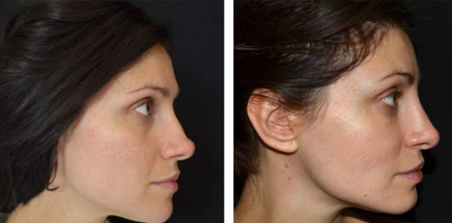 Курносый нос у девушки. фото, как это выглядит, как исправить, ринопластика, до и после операции