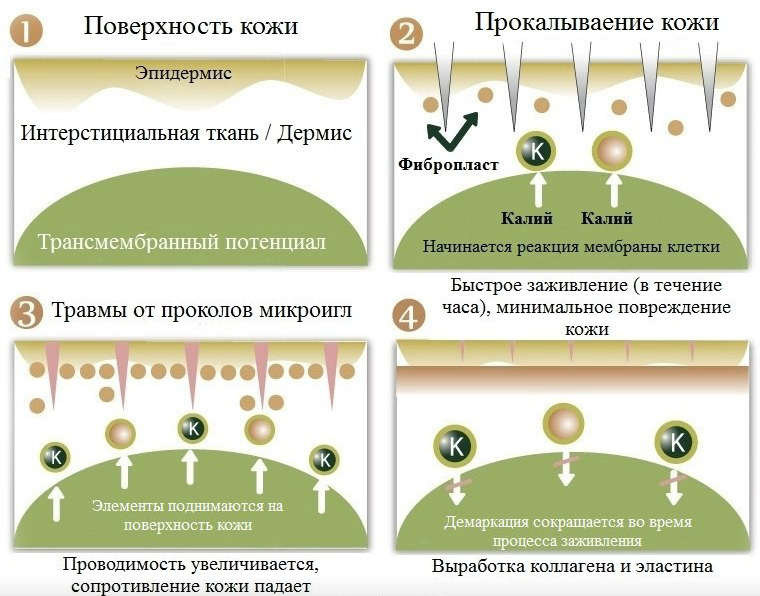 Что такое фракционная мезотерапия: эффективность процедуры для кожи лица и ее разновидности