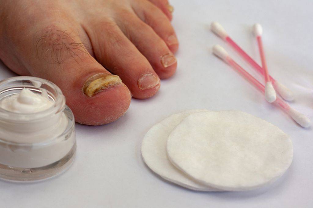 Лечение грибка ногтей на ногах и руках
