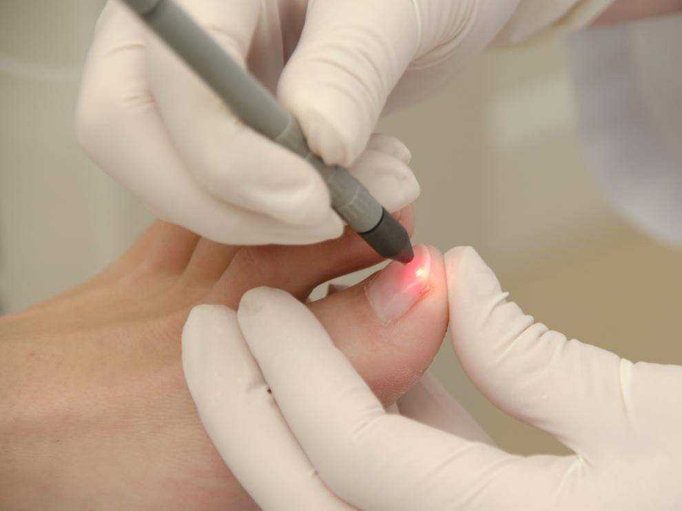 Лазерное удаление грибка ногтей - какие виды лазера используются, техника лечения