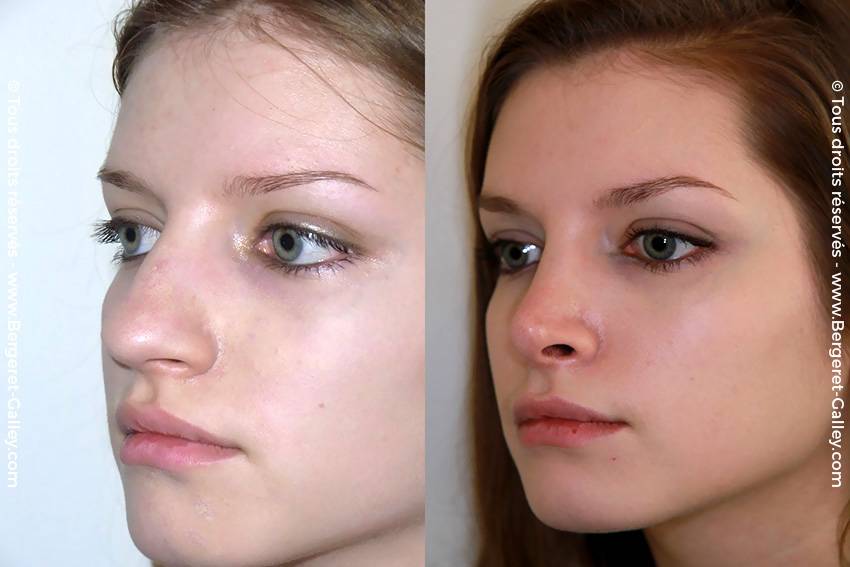 Ринопластика кончика носа. отчет пациентки