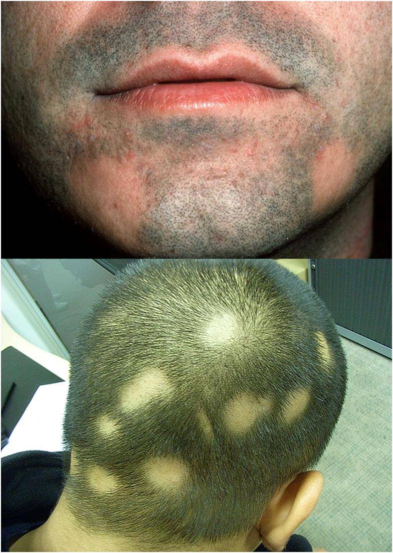 От чего появляются волосы на лице у мужчин