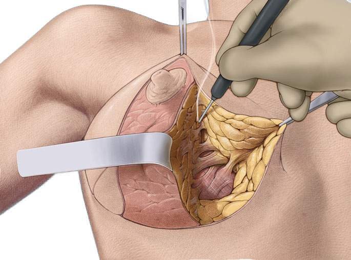Методы подтяжки груди - блог клиники медиэстетик