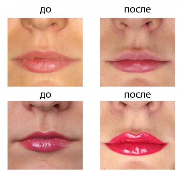 Какое бывает увеличение губ. Формы губ. Форма губ для увеличения. Коррекция формы губ. Формы увеличенных губ.