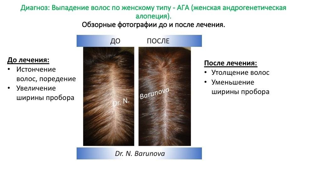 Причины сильного выпадения волос и их лечение