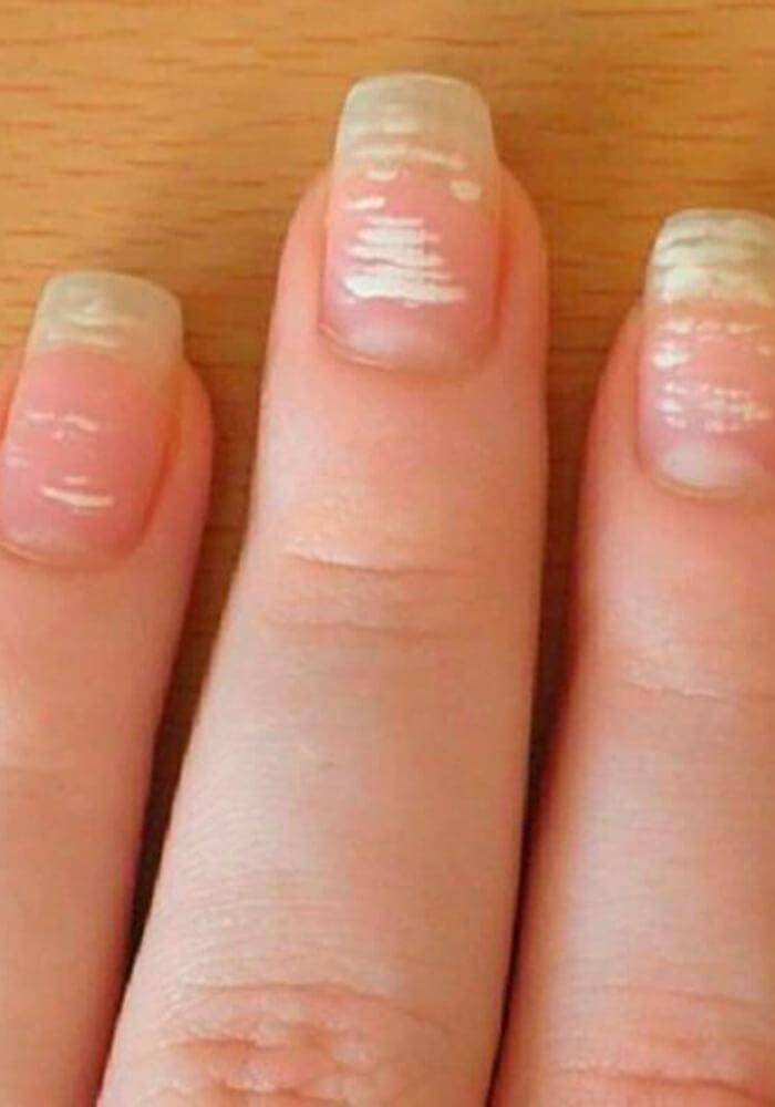 Белые пятна на ногтях: причины, почему появляются белые полосы и пятна на ногтях