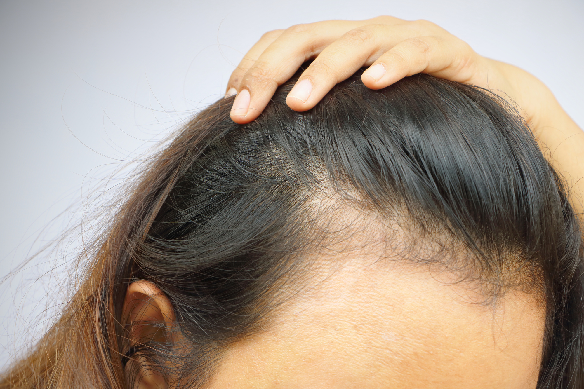 Выпадение волос (алопеция) - симптомы и лечение