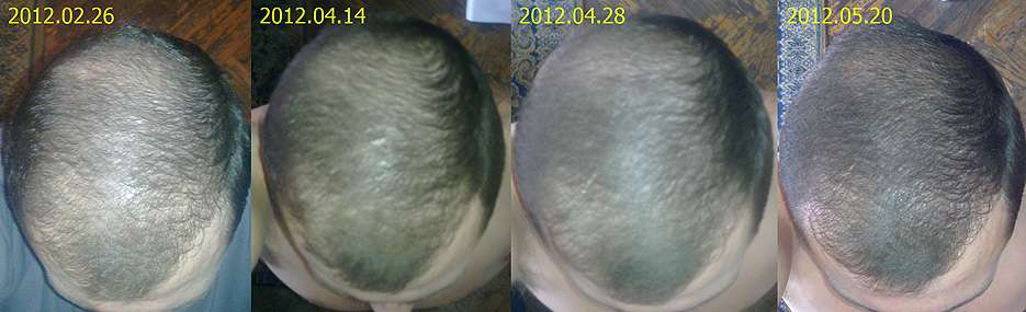 Как восстановить волосы после химиотерапии, как ускорить рост, когда можно красить, обзор полезных средств