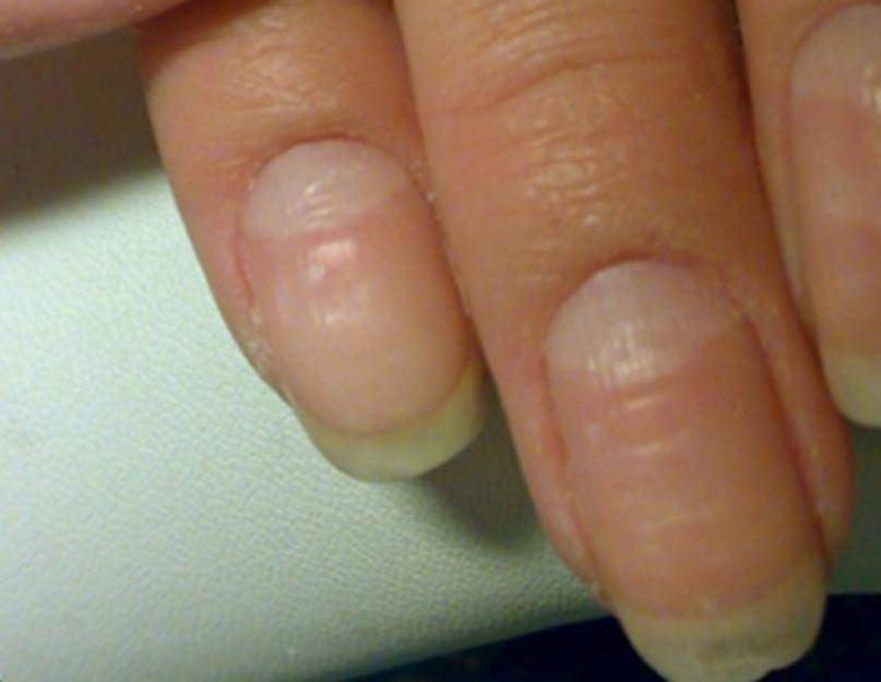Почему ногти на руках стали волнистыми: лечение и профилактика