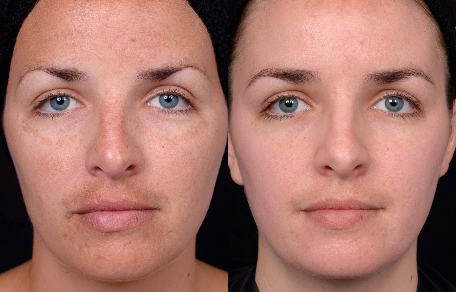Глубокая чистка лица фото до и после