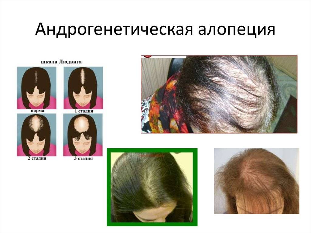 Основные виды алопеции (выпадения волос) и причины алопеции