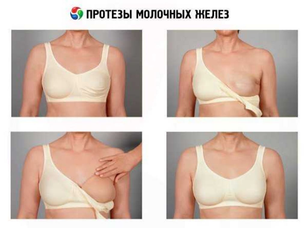Коррекция груди (маммопластика)
